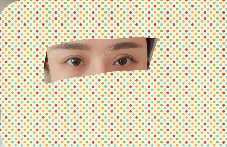 更美 - 更美用户yYrzOnaU0o的经验 | 修复双眼皮