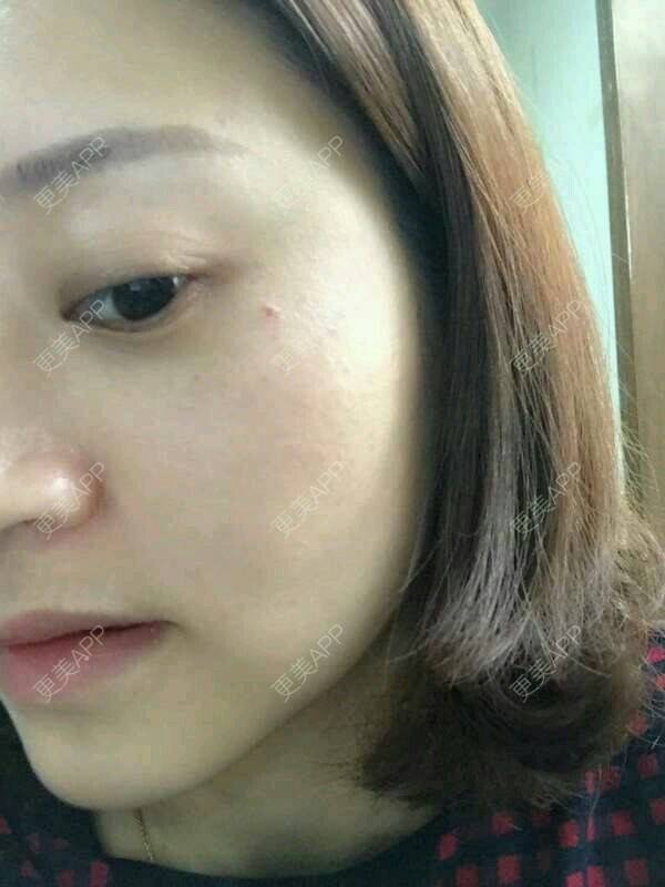 更美 - 马佳妞的激光淡斑经验 | 激光淡斑 | 晒侧颜 | 郑州