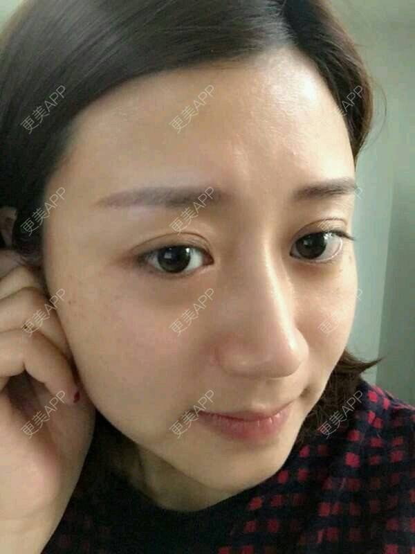 更美 - 马佳妞的激光淡斑经验 | 激光淡斑 | 晒侧颜 | 郑州