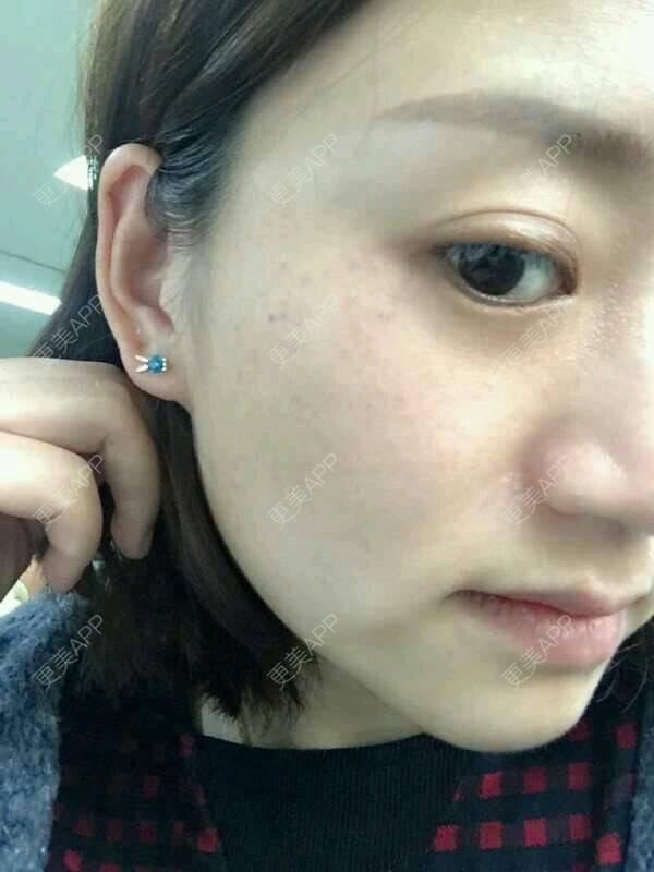 更美 - 马佳妞的激光淡斑经验 | 激光淡斑 | 晒侧颜 | 郑州