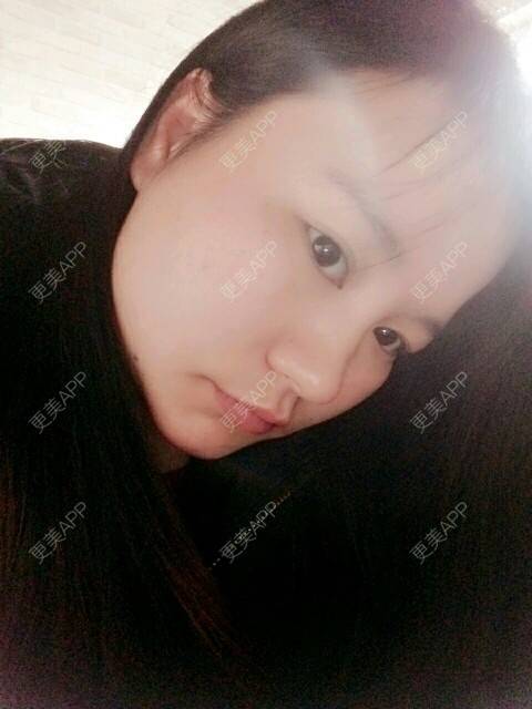 更美 - 更美用户88579315的经验 | 面部轮廓 | 颧骨颧弓 | 你看我整哪 | 南京