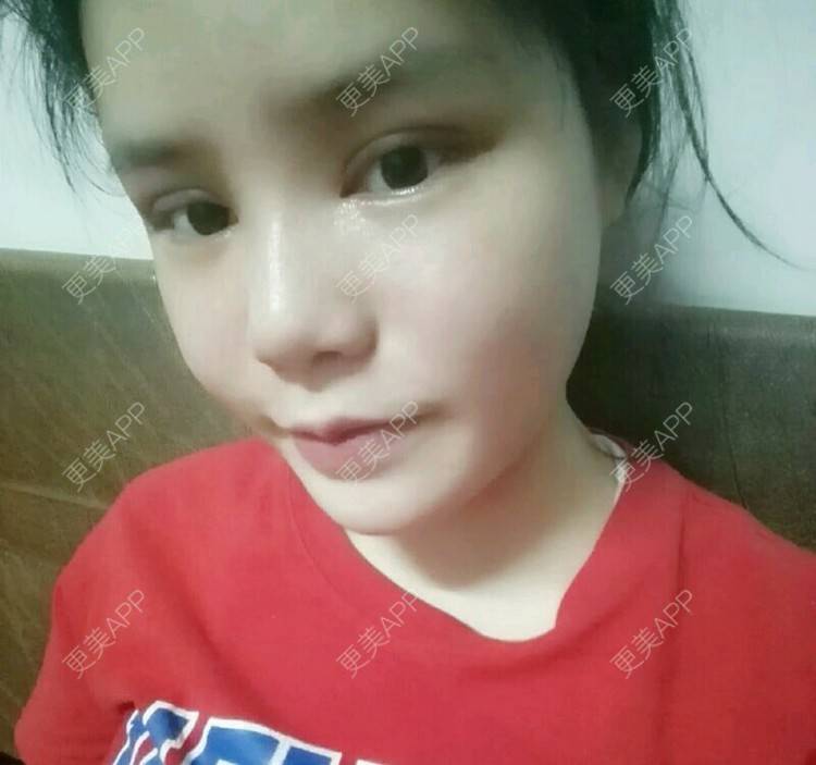 更美 - 我不是萌妹纸的全切双眼皮经验 | 面部轮廓 | 全切双眼皮 | 面颈吸脂 | 深圳