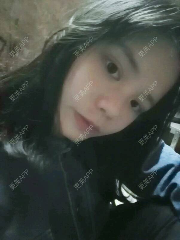 更美 - 我不是萌妹纸的全切双眼皮经验 | 面部轮廓 | 全切双眼皮 | 面颈吸脂 | 深圳