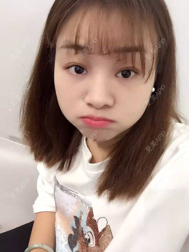 更美 - Mimo 兰的眼皮下垂矫正经验 | 上海 | 眼皮下垂矫正