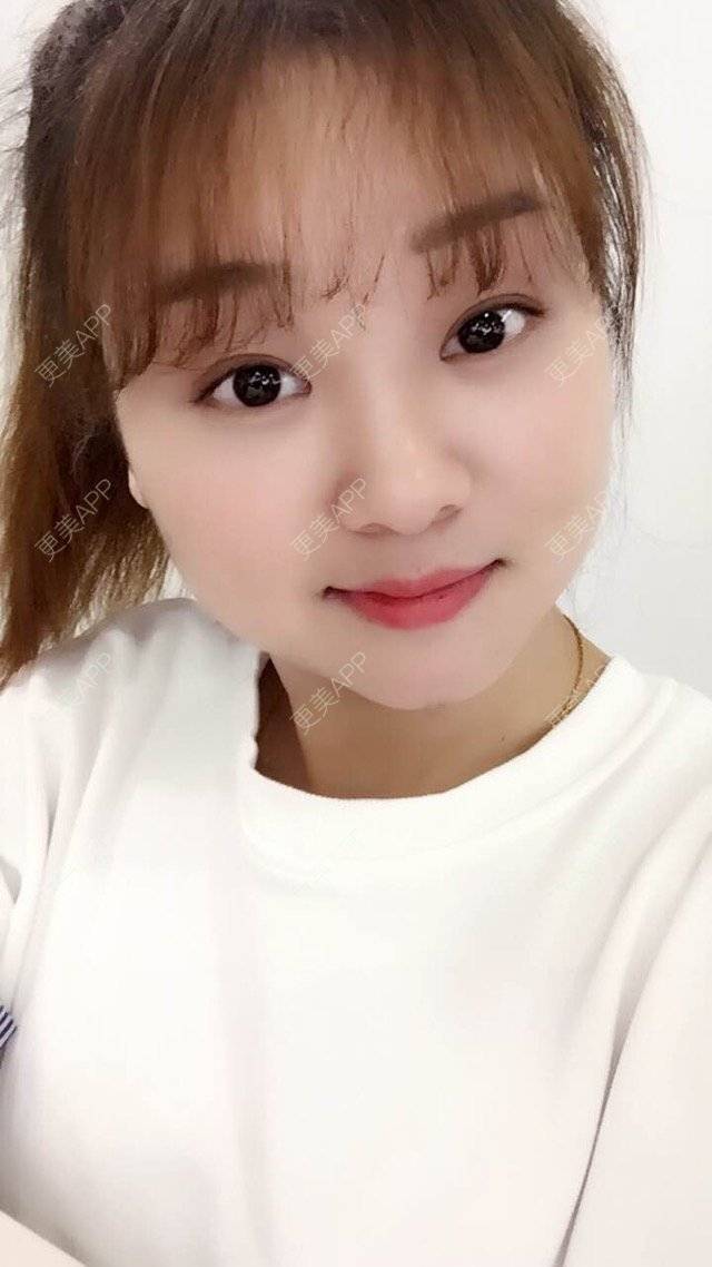 更美 - Mimo 兰的眼皮下垂矫正经验 | 上海 | 眼皮下垂矫正