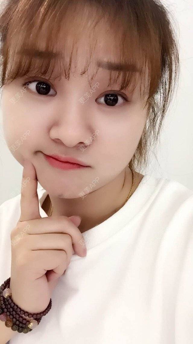 更美 - Mimo 兰的眼皮下垂矫正经验 | 上海 | 眼皮下垂矫正