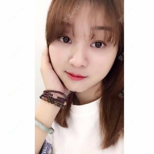 更美 - Mimo 兰的眼皮下垂矫正经验 | 上海 | 眼皮下垂矫正