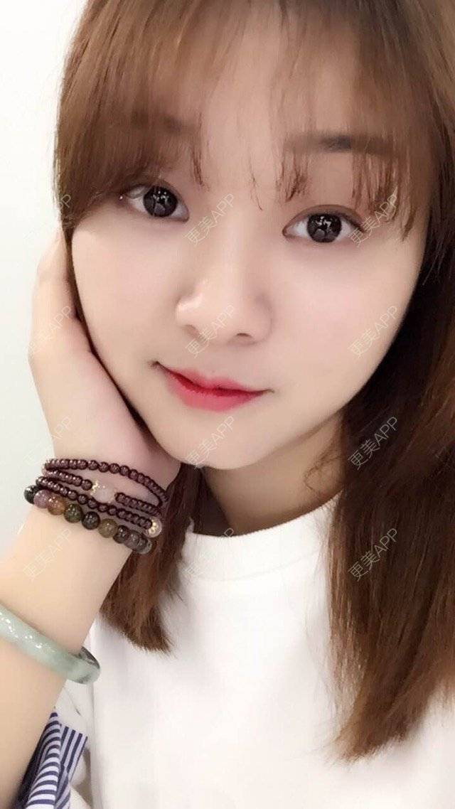 更美 - Mimo 兰的眼皮下垂矫正经验 | 上海 | 眼皮下垂矫正