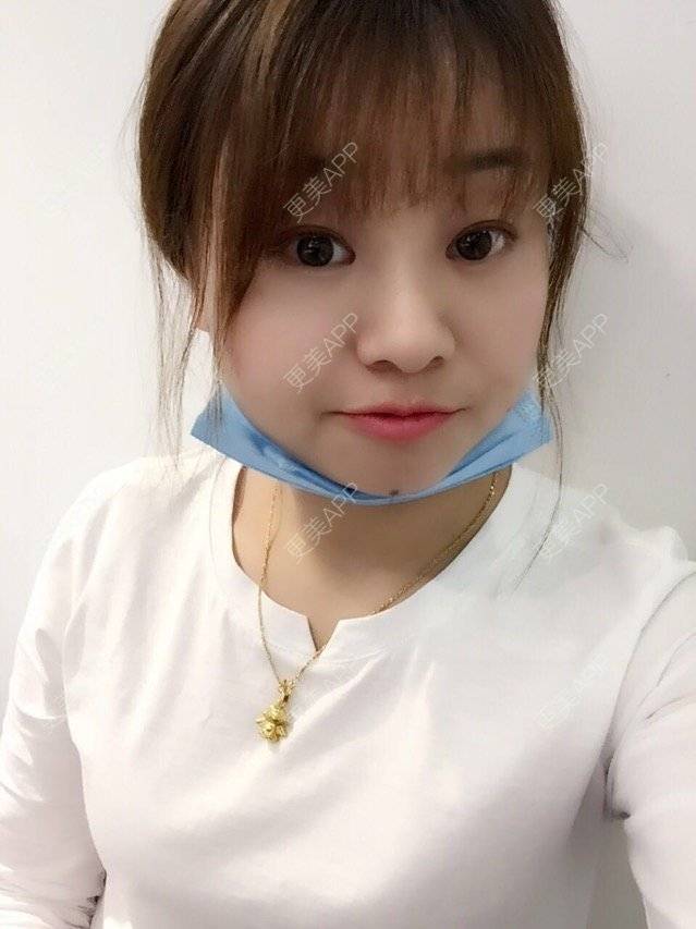 更美 - Mimo 兰的眼皮下垂矫正经验 | 上海 | 眼皮下垂矫正