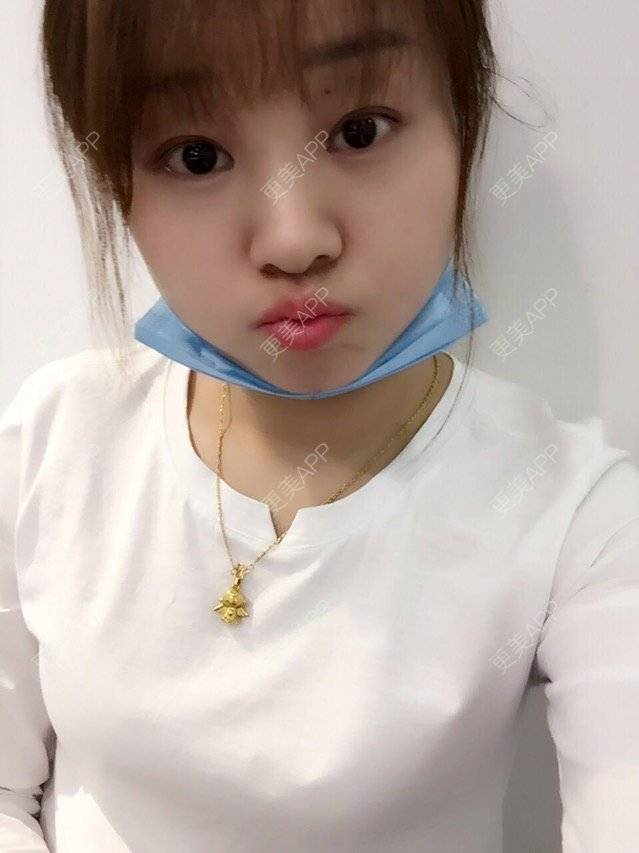 更美 - Mimo 兰的眼皮下垂矫正经验 | 上海 | 眼皮下垂矫正