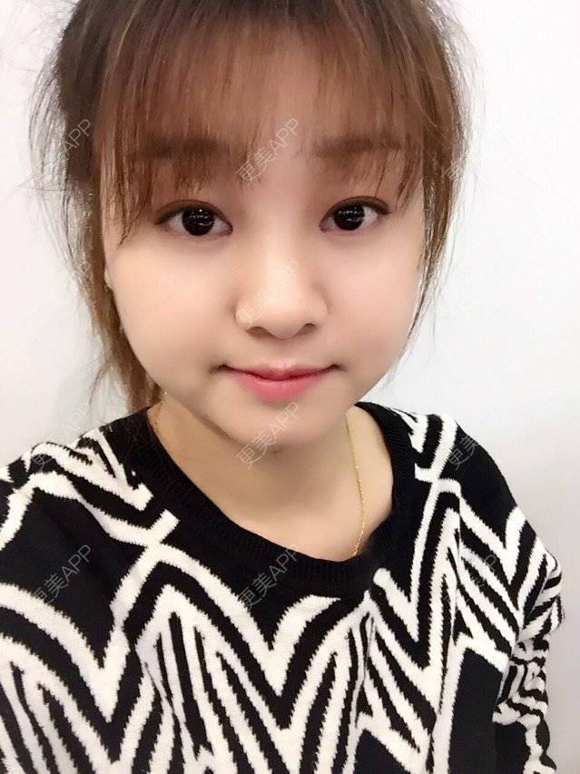 更美 - Mimo 兰的眼皮下垂矫正经验 | 上海 | 眼皮下垂矫正