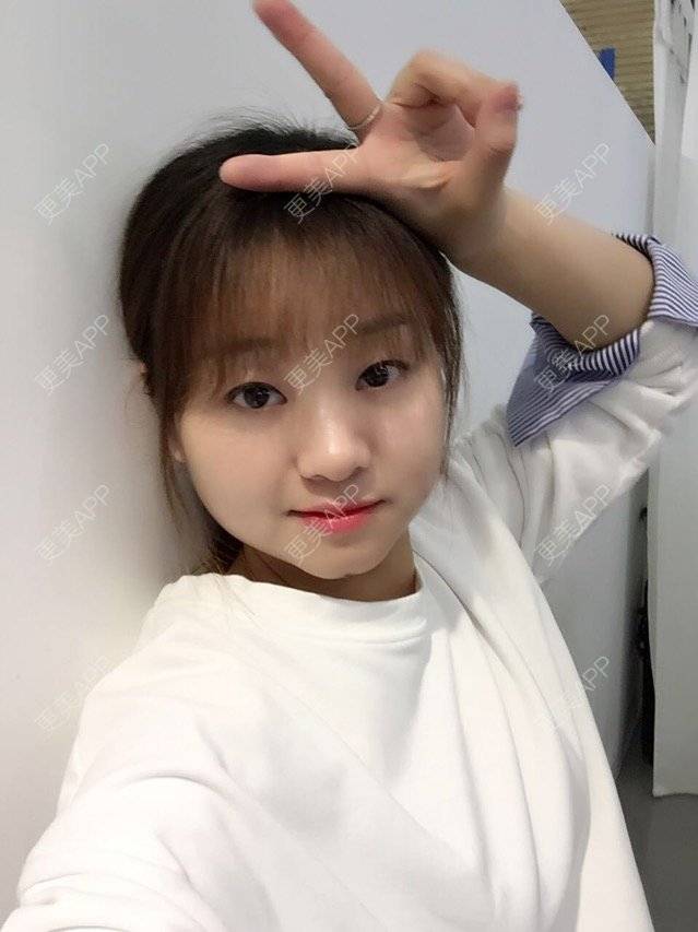更美 - Mimo 兰的眼皮下垂矫正经验 | 上海 | 眼皮下垂矫正
