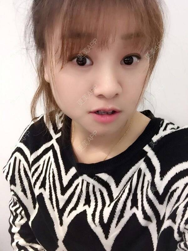 更美 - Mimo 兰的眼皮下垂矫正经验 | 上海 | 眼皮下垂矫正