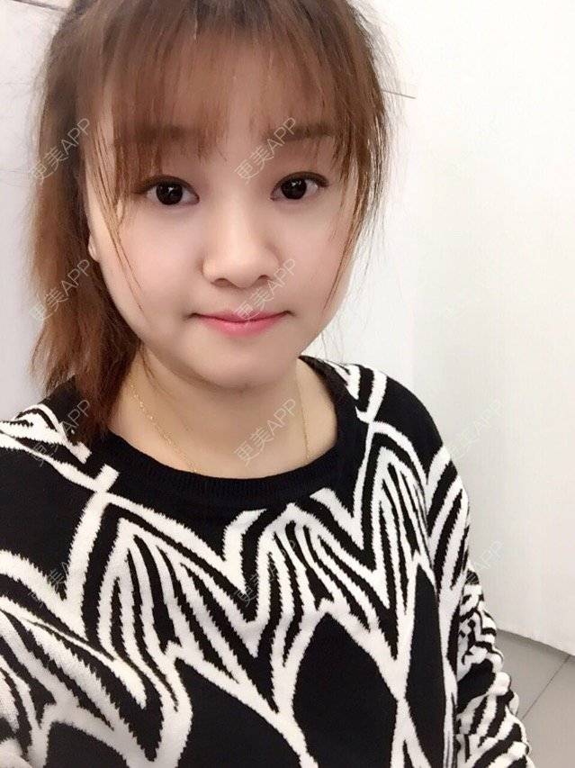 更美 - Mimo 兰的眼皮下垂矫正经验 | 上海 | 眼皮下垂矫正