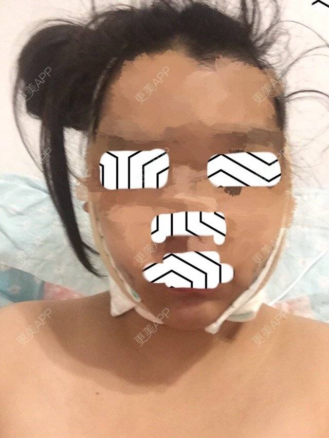 更美 - n1cuhe的吸脂经验 | 吸脂瘦大腿 | 面颈吸脂 | 成都