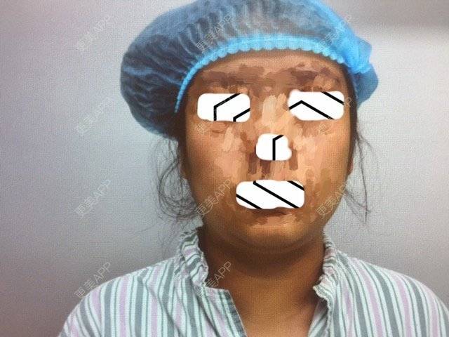 更美 - n1cuhe的吸脂经验 | 吸脂瘦大腿 | 面颈吸脂 | 成都