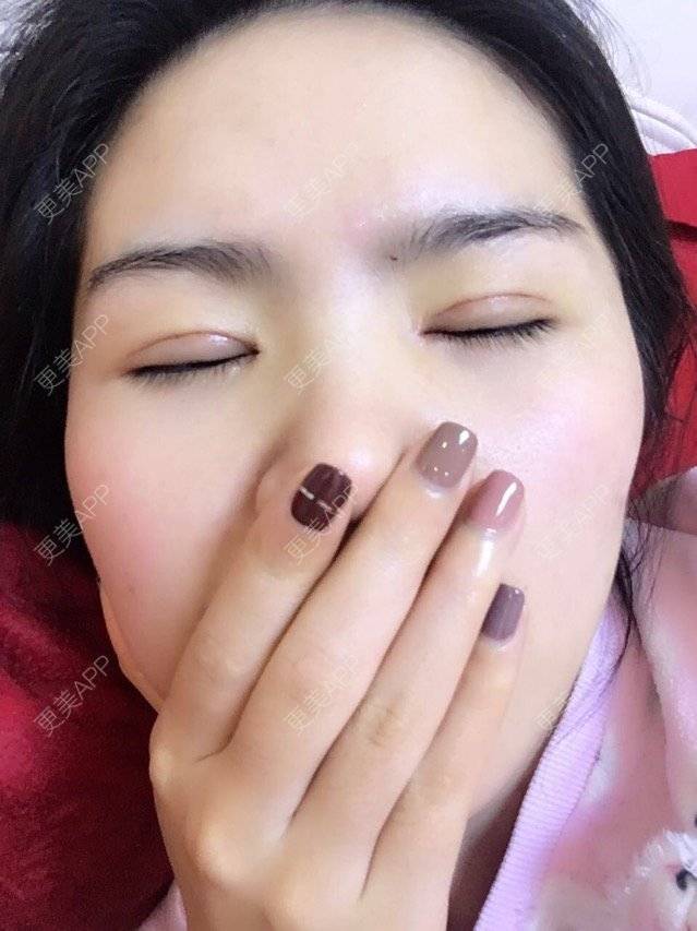 桂共颠桂锁的全切双眼皮日记