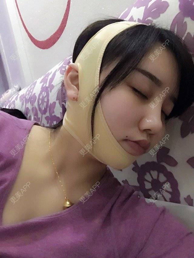 更美 - 桃哥哥 🚶🏼的经验 | 面吸 | 下面部吸脂 | 射频溶脂 | 镇江