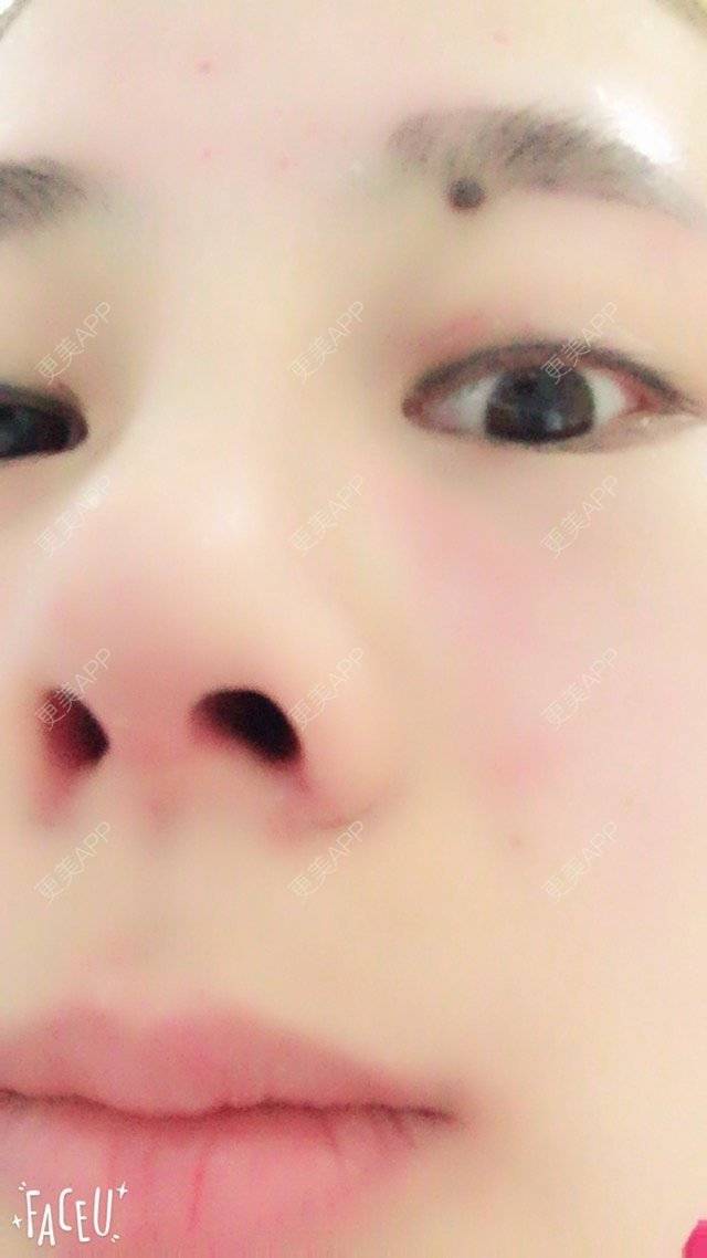 更美 - 李生蚝的鼻部多项经验 | 美购日记 | 鼻综合修复 | 鼻部多项 | 自体耳软骨垫鼻尖 | 上海