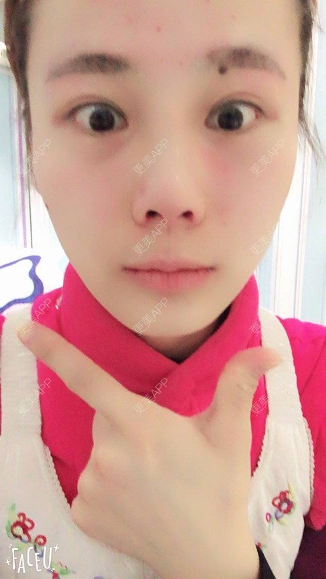 更美 - 李生蚝的鼻部多项经验 | 美购日记 | 鼻综合修复 | 鼻部多项 | 自体耳软骨垫鼻尖 | 上海