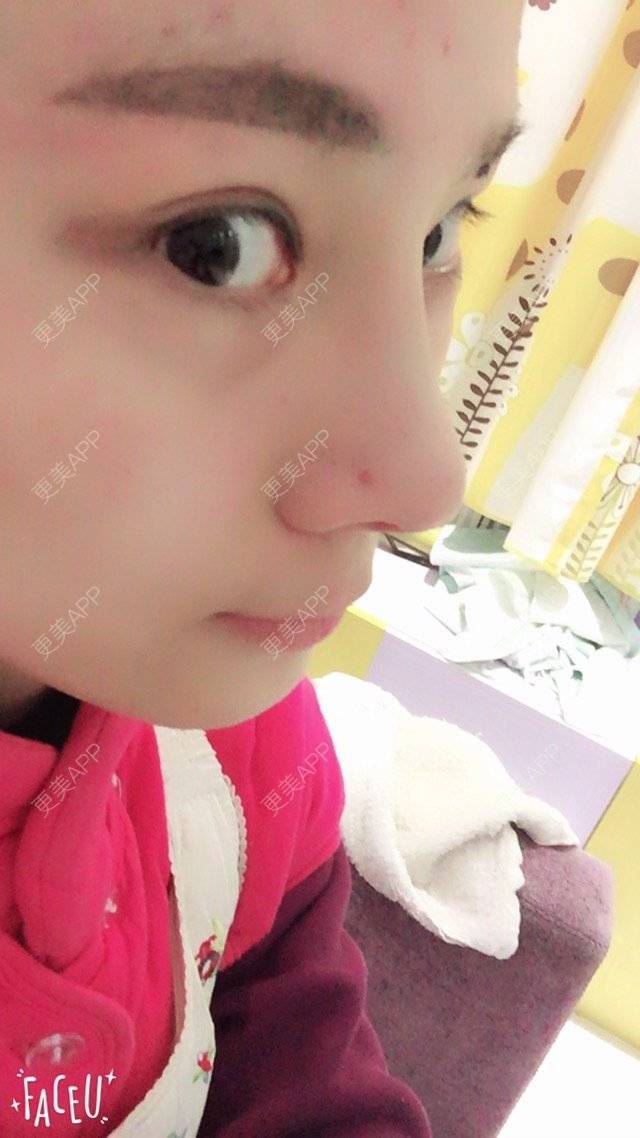 更美 - 李生蚝的鼻部多项经验 | 美购日记 | 鼻综合修复 | 鼻部多项 | 自体耳软骨垫鼻尖 | 上海