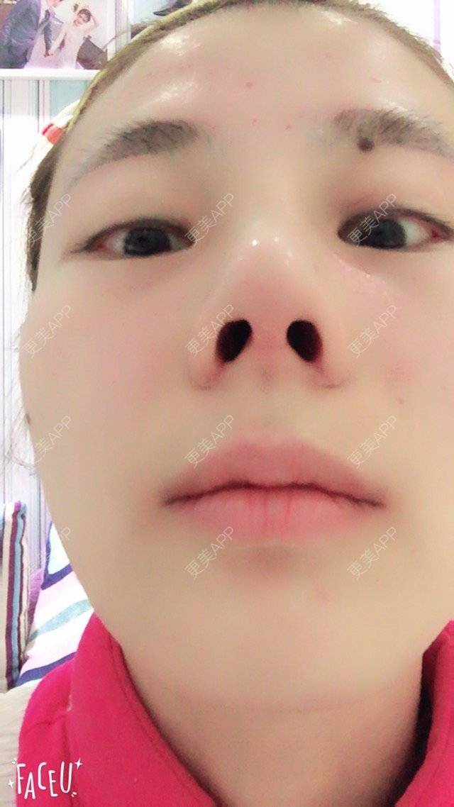更美 - 李生蚝的鼻部多项经验 | 美购日记 | 鼻综合修复 | 鼻部多项 | 自体耳软骨垫鼻尖 | 上海