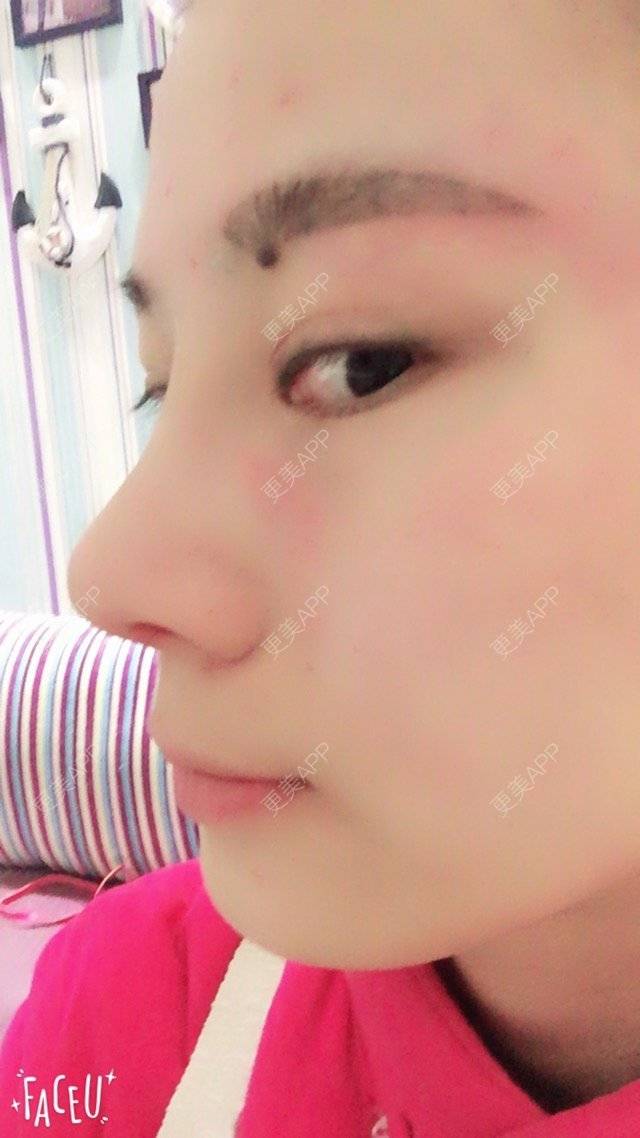 更美 - 李生蚝的鼻部多项经验 | 美购日记 | 鼻综合修复 | 鼻部多项 | 自体耳软骨垫鼻尖 | 上海