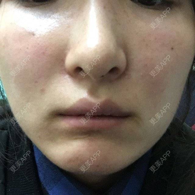 更美 - 杉哥哥的经验 | 玻尿酸苹果肌 | 上海