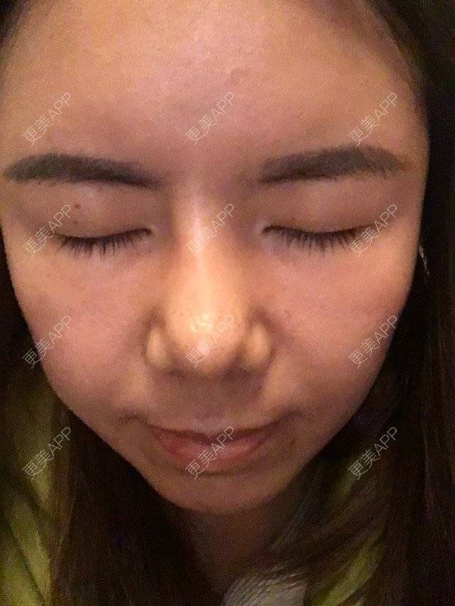 更美 - 彭安心的经验 | 鼻部整形 | 鼻中隔延长 | 膨体隆鼻加耳软骨延长鼻尖 | 杭州