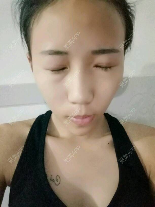更美 - 是婉如的全切双眼皮经验 | 美购日记 | 全切双眼皮 | 南京
