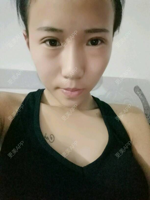 更美 - 是婉如的全切双眼皮经验 | 美购日记 | 全切双眼皮 | 南京