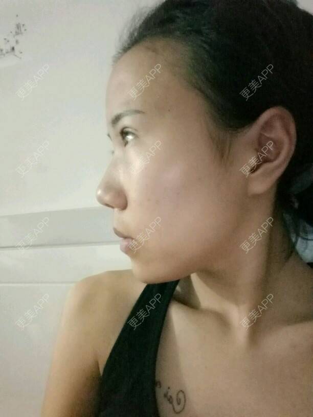 更美 - 是婉如的全切双眼皮经验 | 美购日记 | 全切双眼皮 | 南京