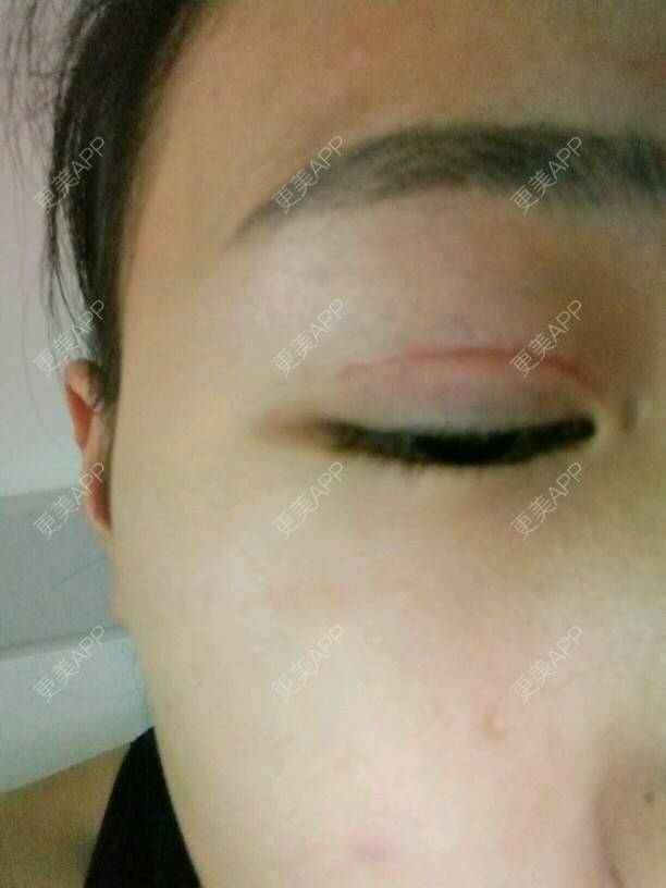 更美 - 是婉如的全切双眼皮经验 | 美购日记 | 全切双眼皮 | 南京