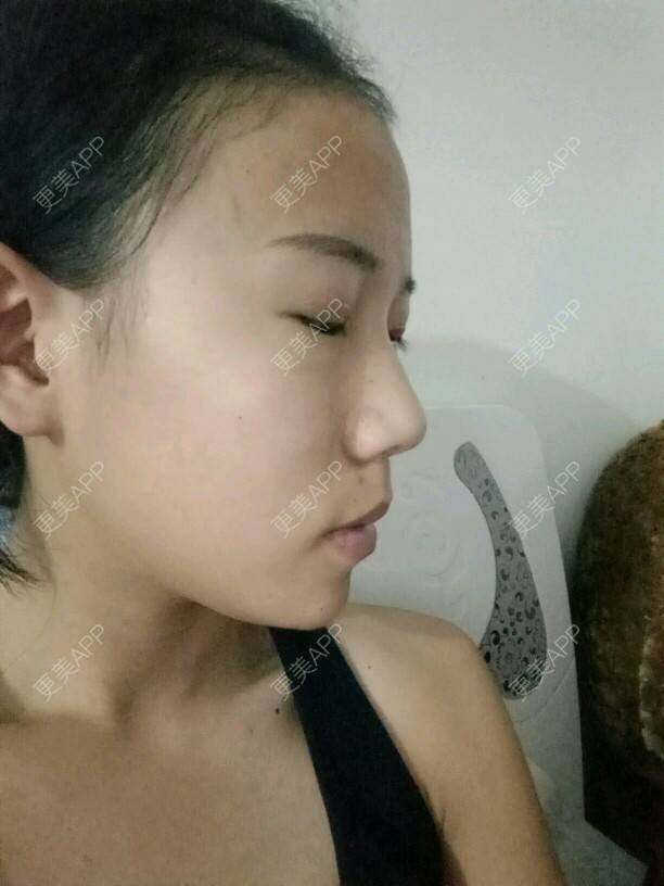 更美 - 是婉如的全切双眼皮经验 | 美购日记 | 全切双眼皮 | 南京