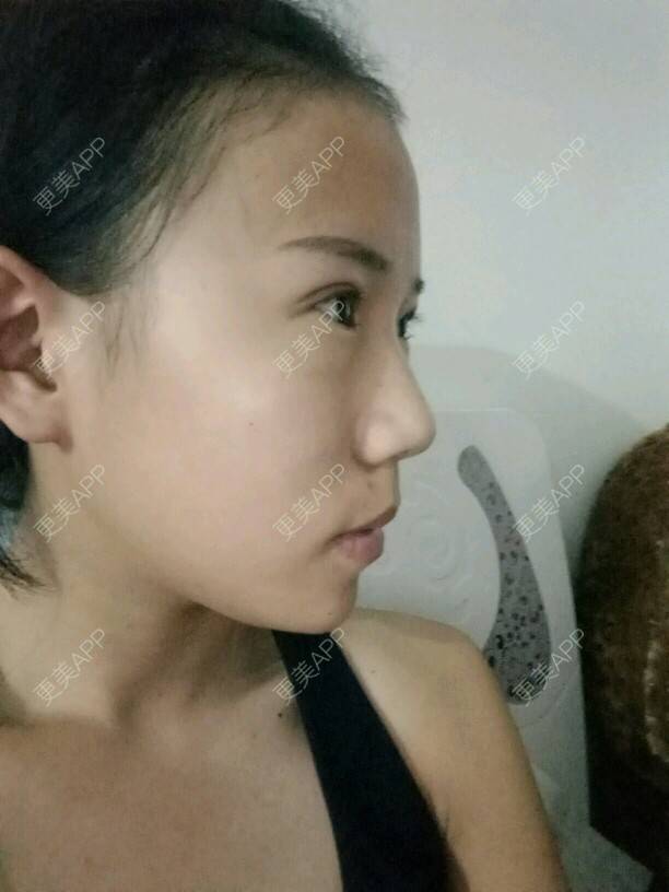 更美 - 是婉如的全切双眼皮经验 | 美购日记 | 全切双眼皮 | 南京