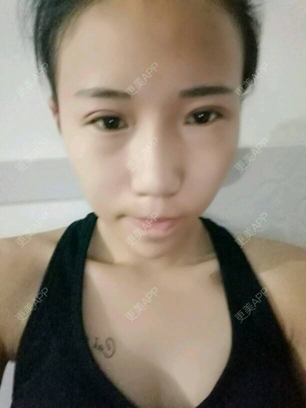 更美 - 是婉如的全切双眼皮经验 | 美购日记 | 全切双眼皮 | 南京
