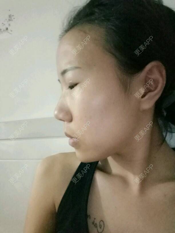更美 - 是婉如的全切双眼皮经验 | 美购日记 | 全切双眼皮 | 南京