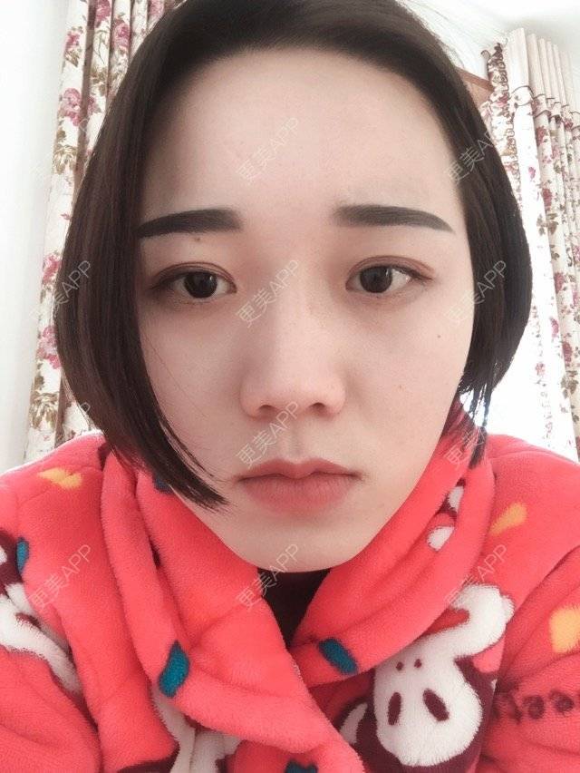更美 - 大M呀的经验 | 双眼皮 | 是否要开内眼角 | 适合开什么眼形 | 武汉