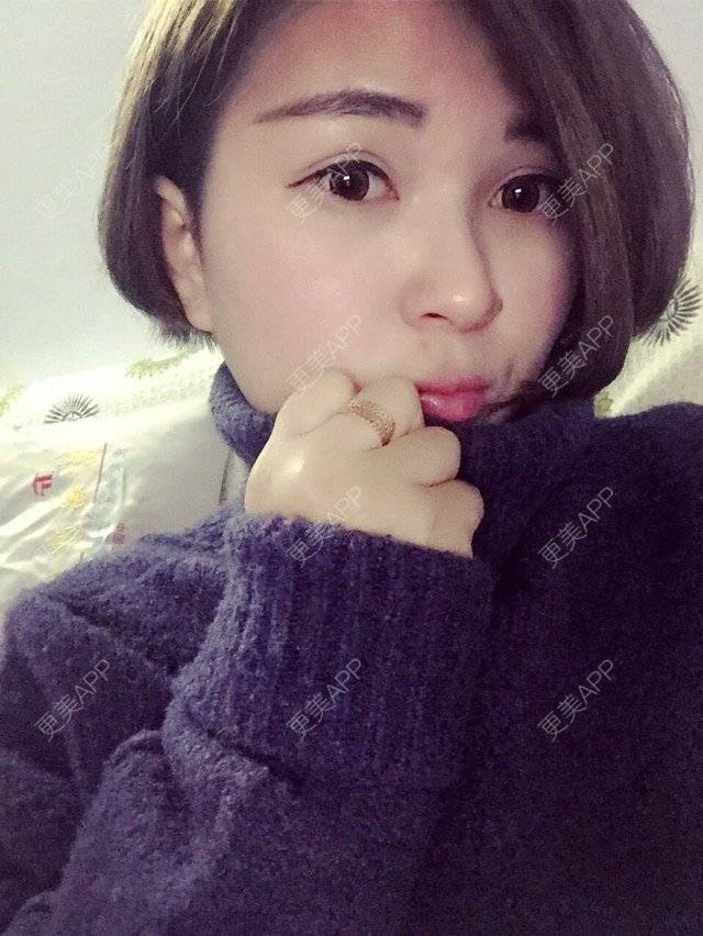 更美 - 韩小舞的全切双眼皮经验 | 全切双眼皮 | 宁波