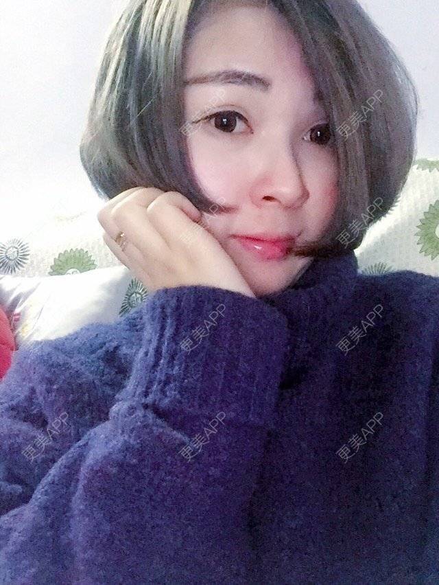 更美 - 韩小舞的全切双眼皮经验 | 全切双眼皮 | 宁波