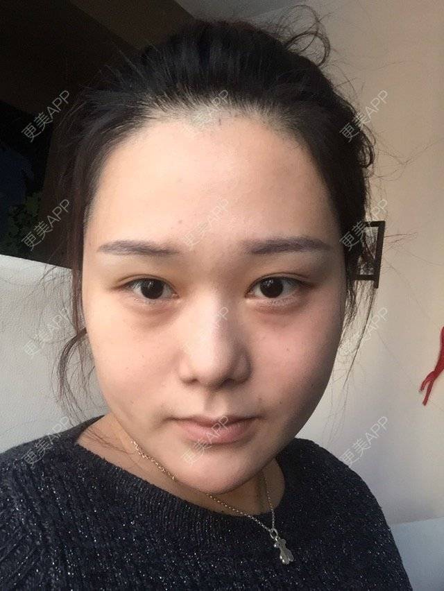 更美 - C0C007🍒的经验 | 外开眼角 | 沈阳