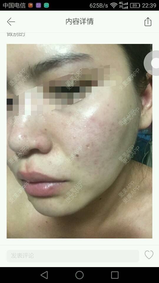 更美 - Rosy11的经验 | 果酸焕肤 | 在线面诊22 | 在线面诊16 | 北京