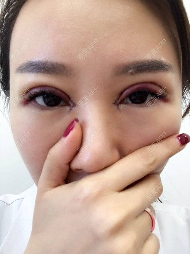 小小小小周的全切双眼皮日记