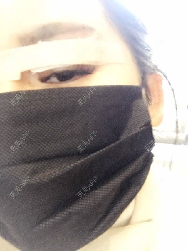 更美 - 小菊花的双眼皮经验 | 上海 | 美购日记 | 埋线双眼皮修复 | 双眼皮