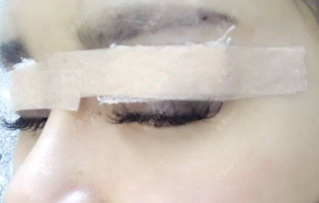 更美 - 小菊花的双眼皮经验 | 上海 | 美购日记 | 埋线双眼皮修复 | 双眼皮
