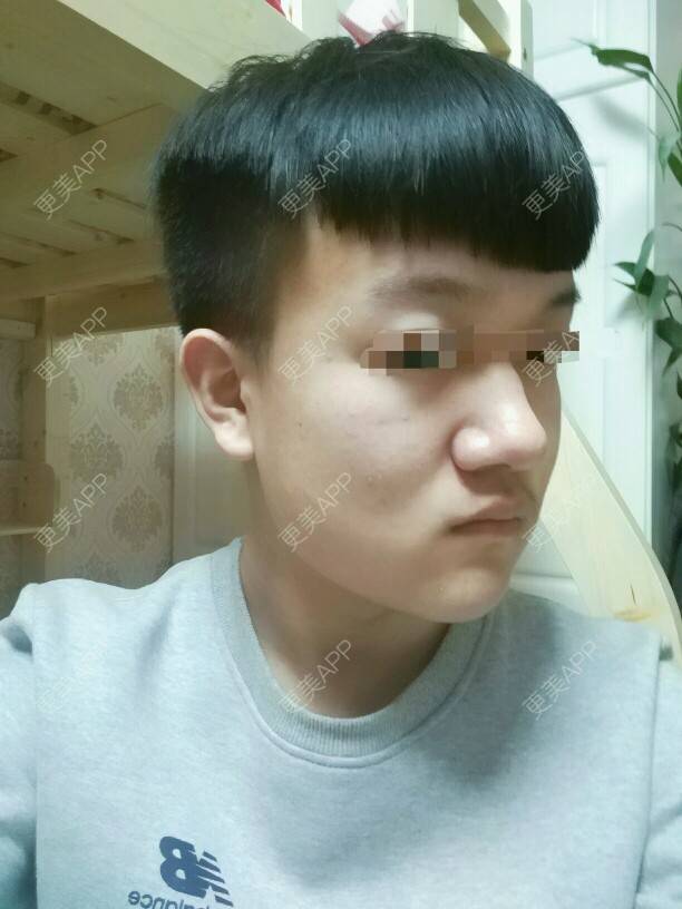 更美 - 更美用户MCCehPOJ1W的经验 | 鼻头缩小 | 哈尔滨
