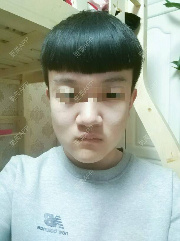 更美 - 更美用户MCCehPOJ1W的经验 | 鼻头缩小 | 哈尔滨