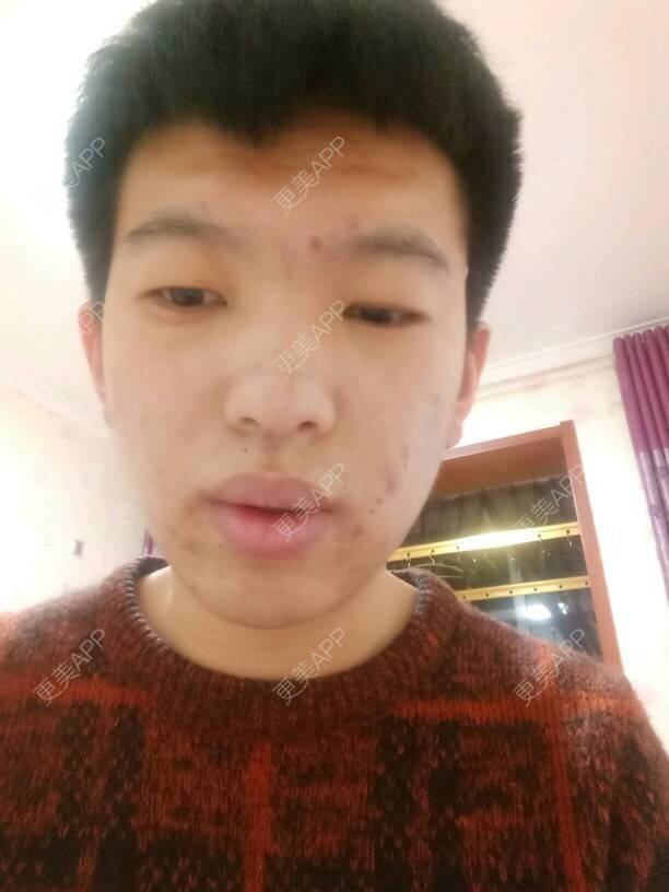 更美 - 更美用户CfS7rAVF4Z的经验 | 美白祛痘祛痘印 | 长治