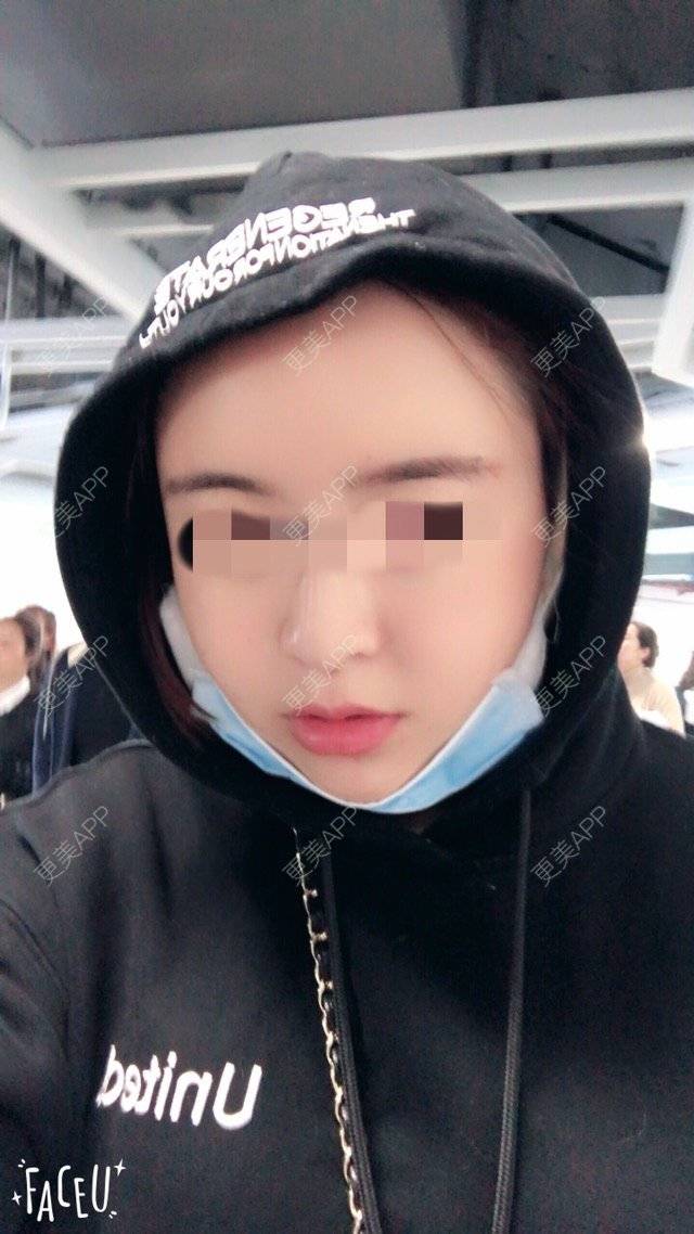 更美 - 泡泡猪猪的经验 | 美购日记 | 上臂吸脂 | 自体脂肪填充额头 | 深圳