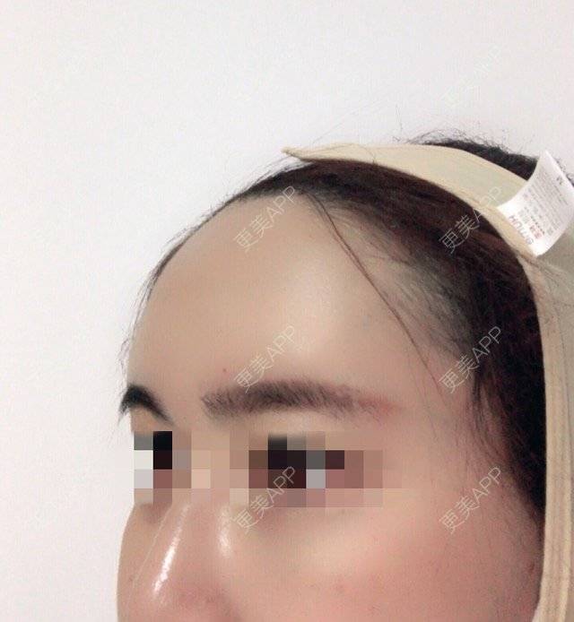 更美 - 泡泡猪猪的经验 | 美购日记 | 上臂吸脂 | 自体脂肪填充额头 | 深圳